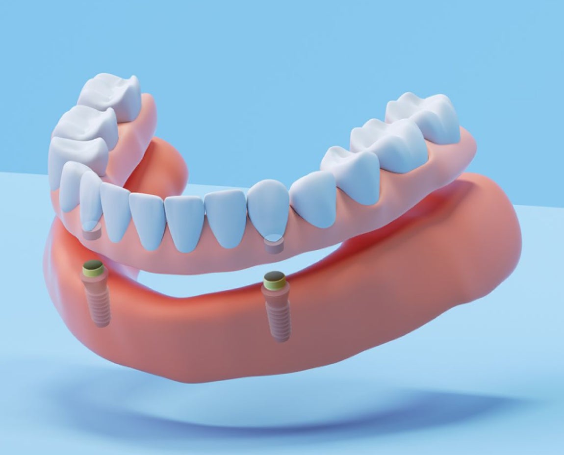 Illustrative example of removable dental implants from Google Search