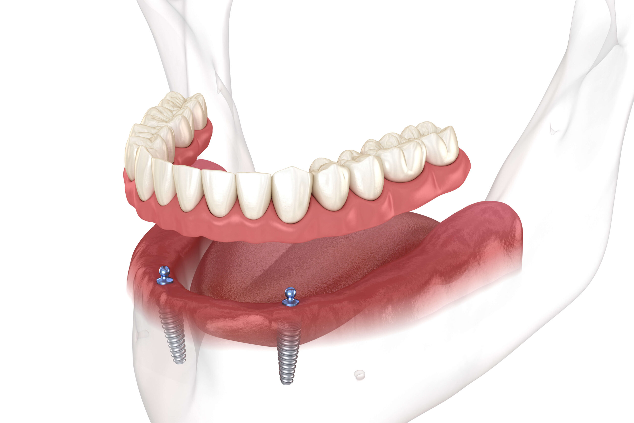 Illustrative example of removable dental implants from Google Search
