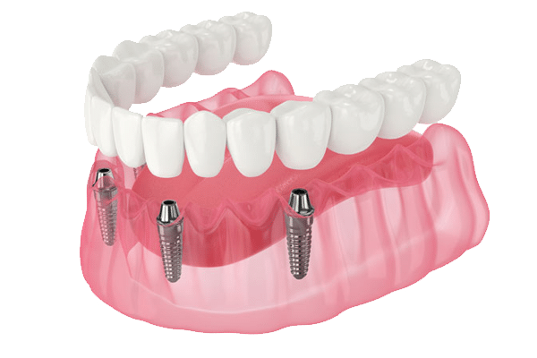 Illustrative example of renew dental implants from Google Search