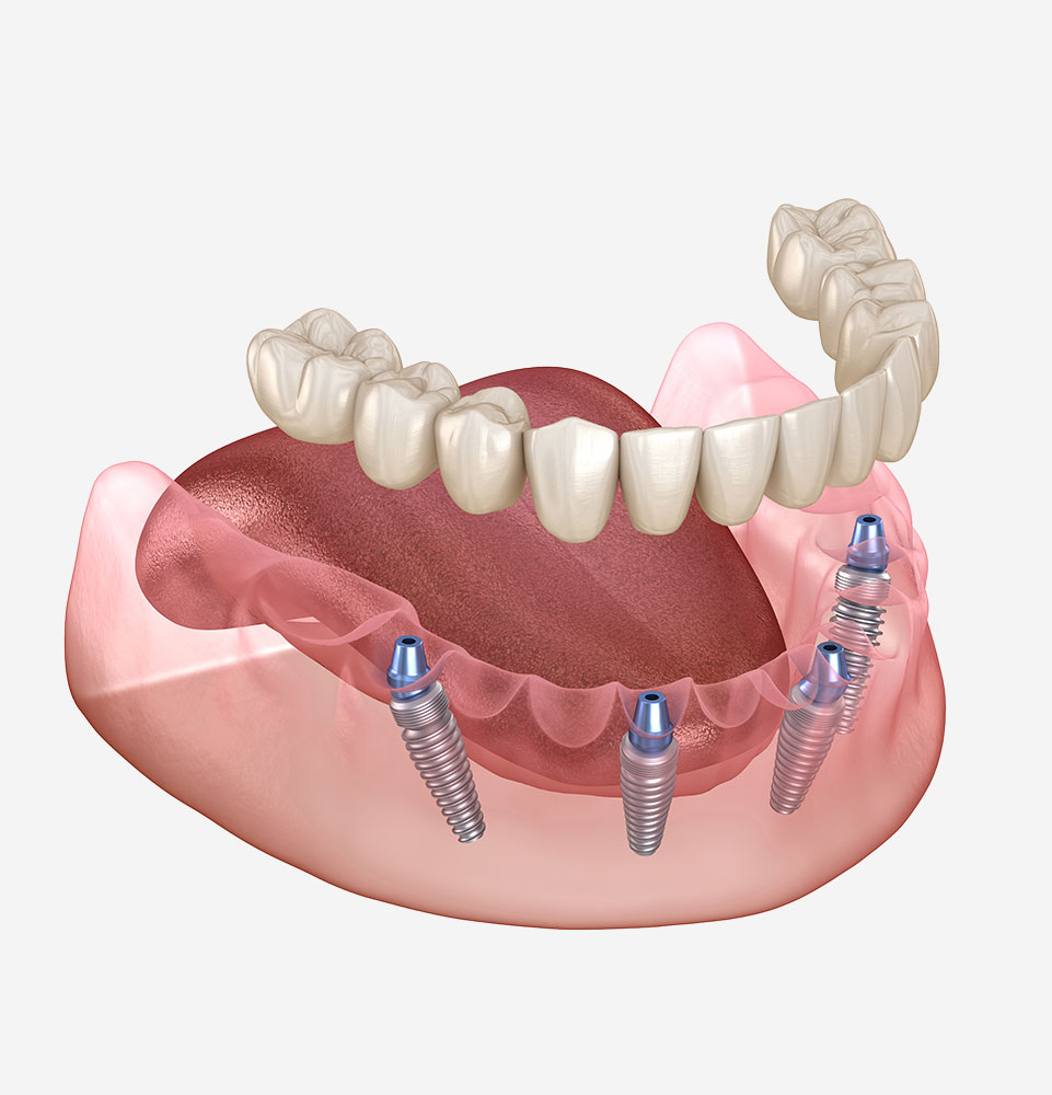 Illustrative example of renew dental implants from Google Search