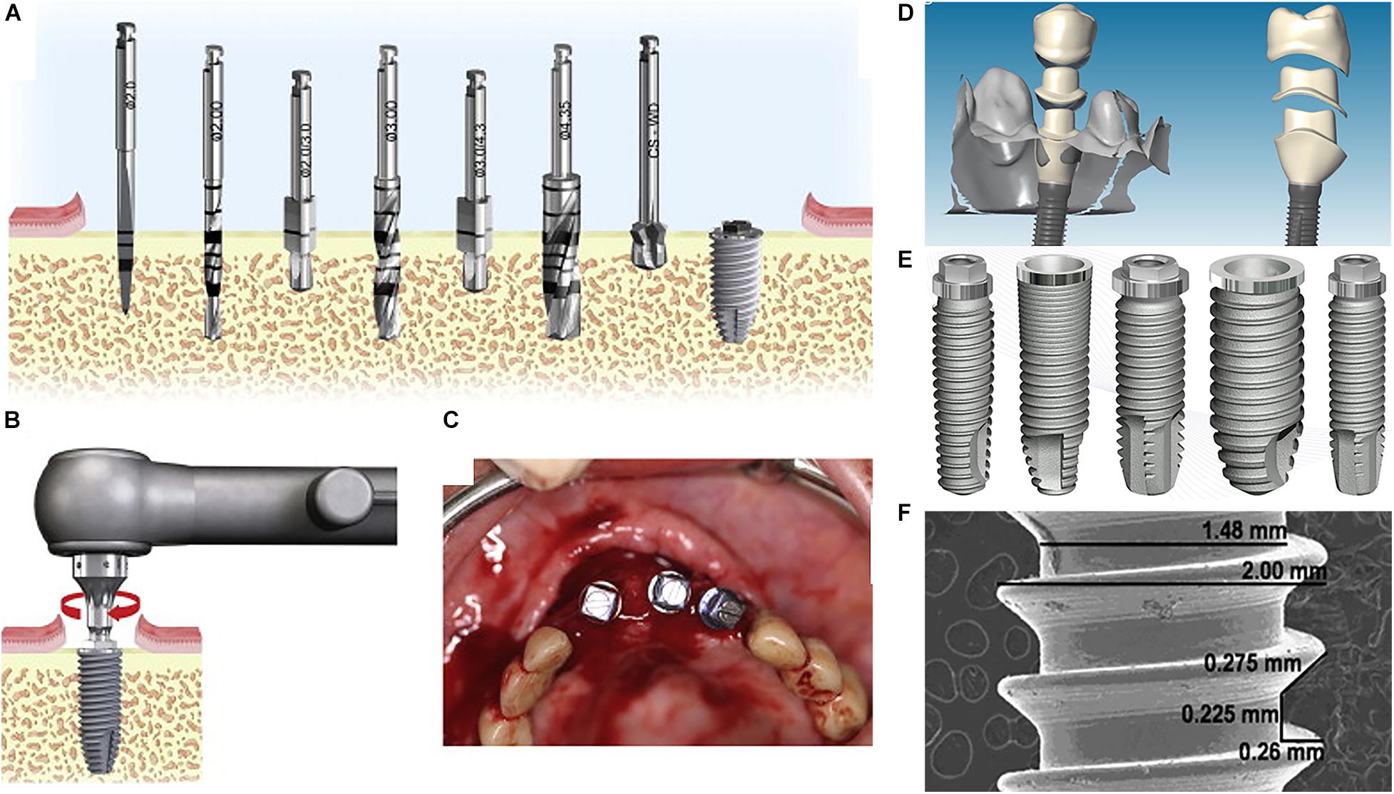 Illustrative example of replacing dental implants from Google Search