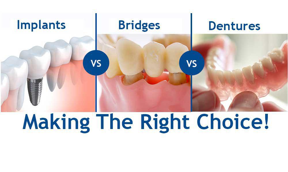 Illustrative example of replacing dental implants from Google Search