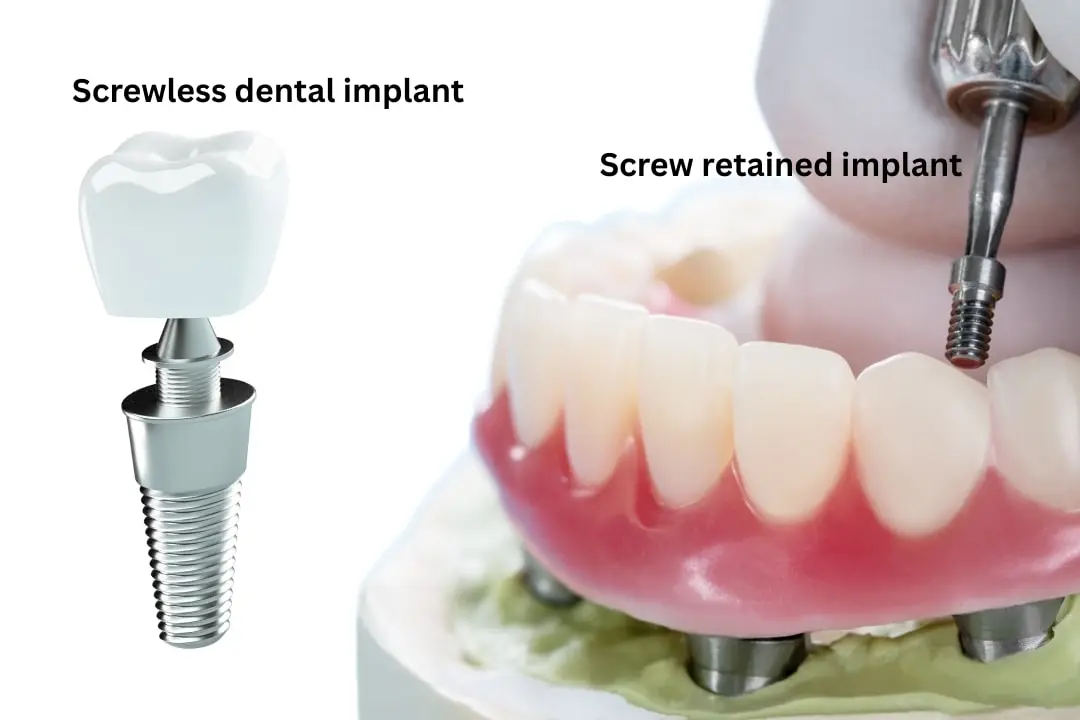 Illustrative example of screwless dental implants for seniors from Google Search