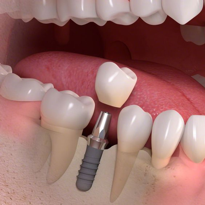 Illustrative example of screwless dental implants for seniors from Google Search