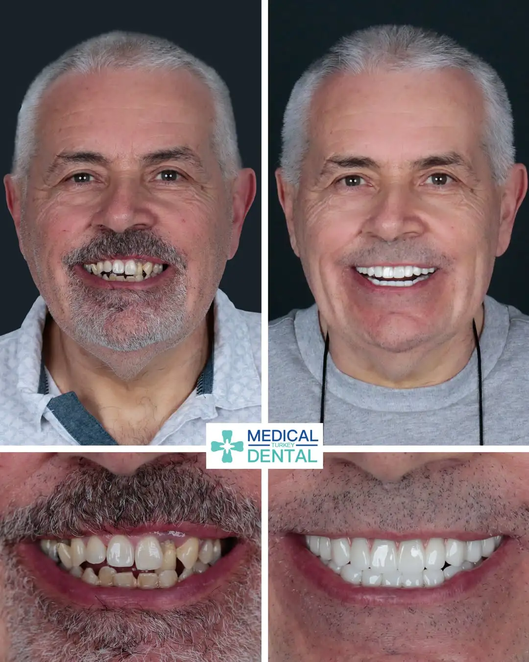 Illustrative example of screwless dental implants from Google Search