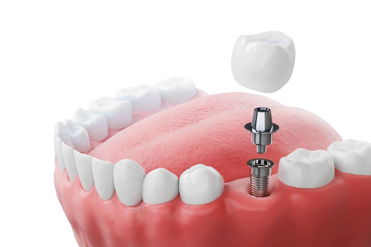 Illustrative example of screwless dental implants from Google Search