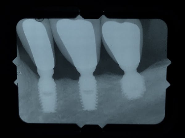 Illustrative example of short dental implants from Google Search