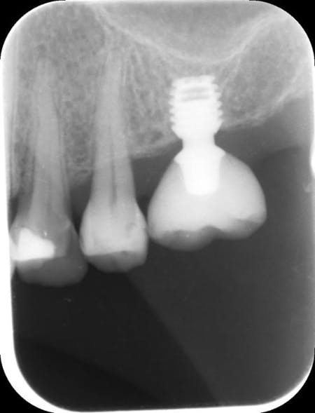 Illustrative example of short dental implants from Google Search