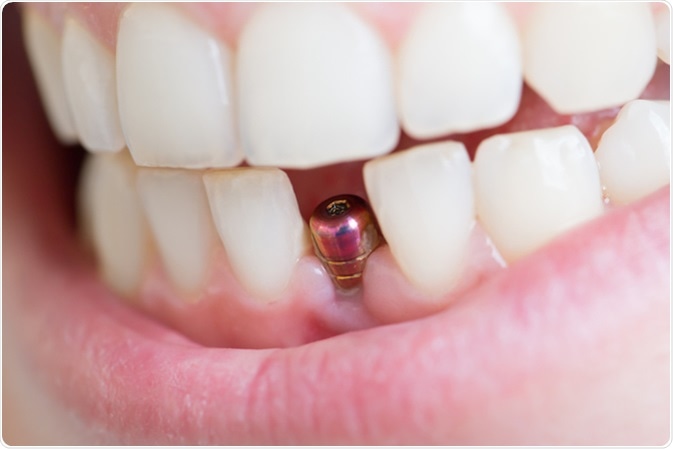 Illustrative example of side effect of dental implants from Google Search