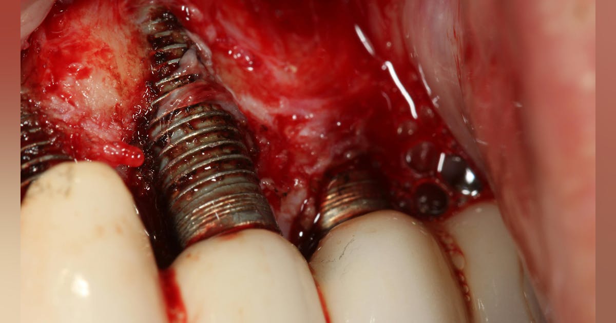Illustrative example of side effect of dental implants from Google Search