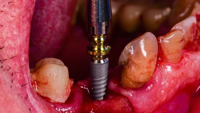Illustrative example of silver dental implants from Google Search