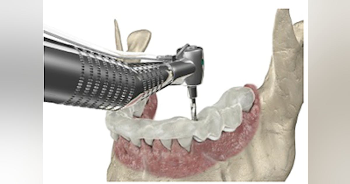 Illustrative example of simple dental implants from Google Search
