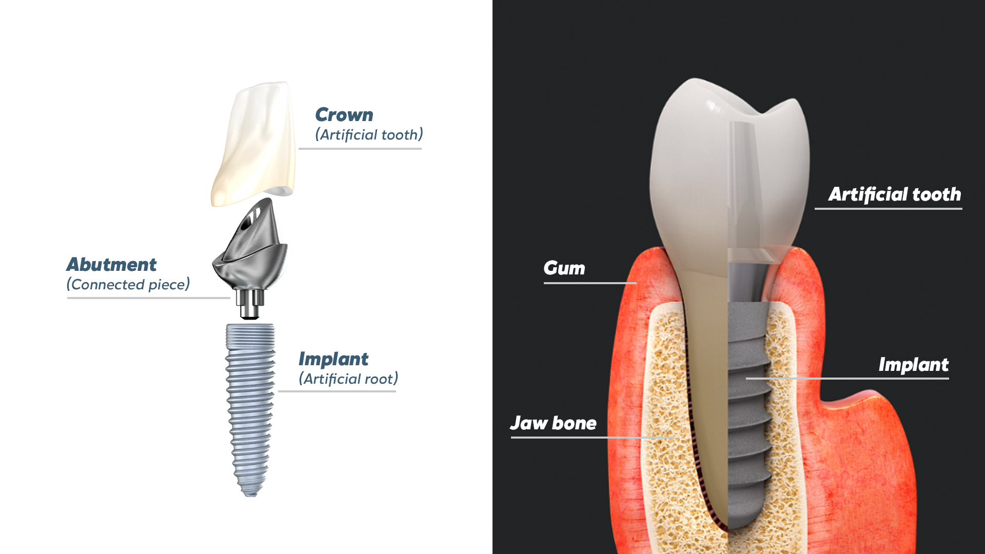 Illustrative example of simple dental implants from Google Search