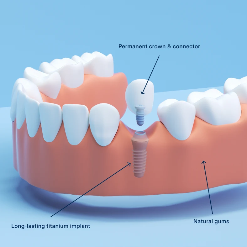 Illustrative example of single tooth dental implants from Google Search