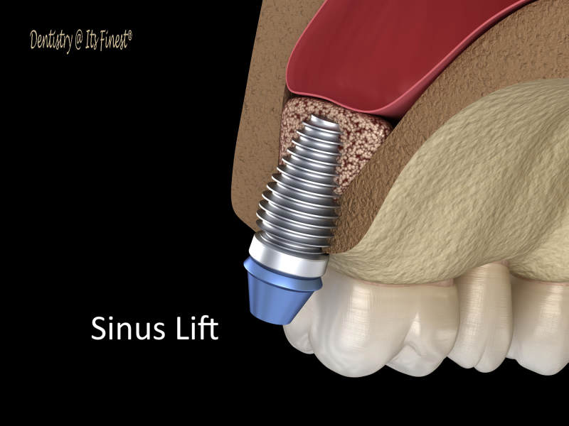 Illustrative example of sinus lifts for dental implants from Google Search