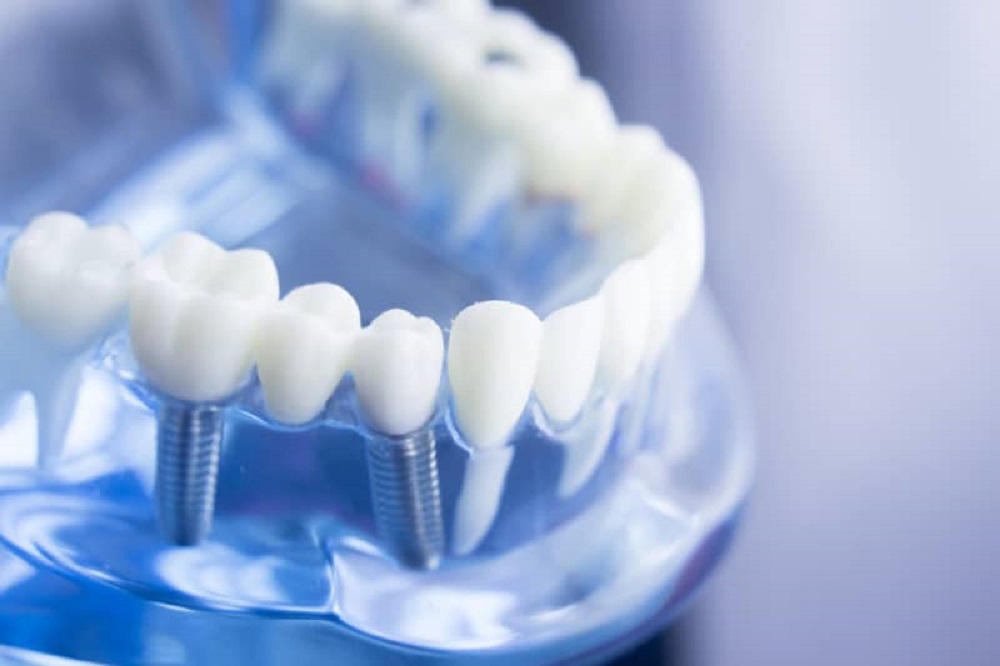 Illustrative example of smart dental implants from Google Search