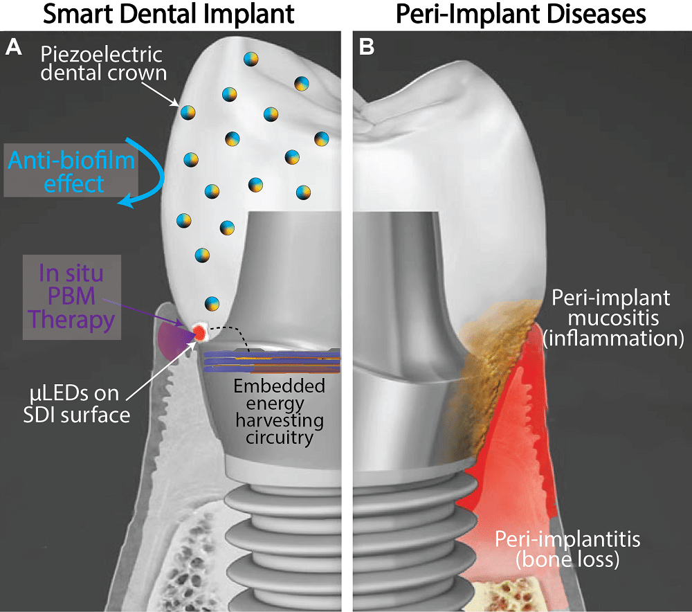 Illustrative example of smart dental implants from Google Search