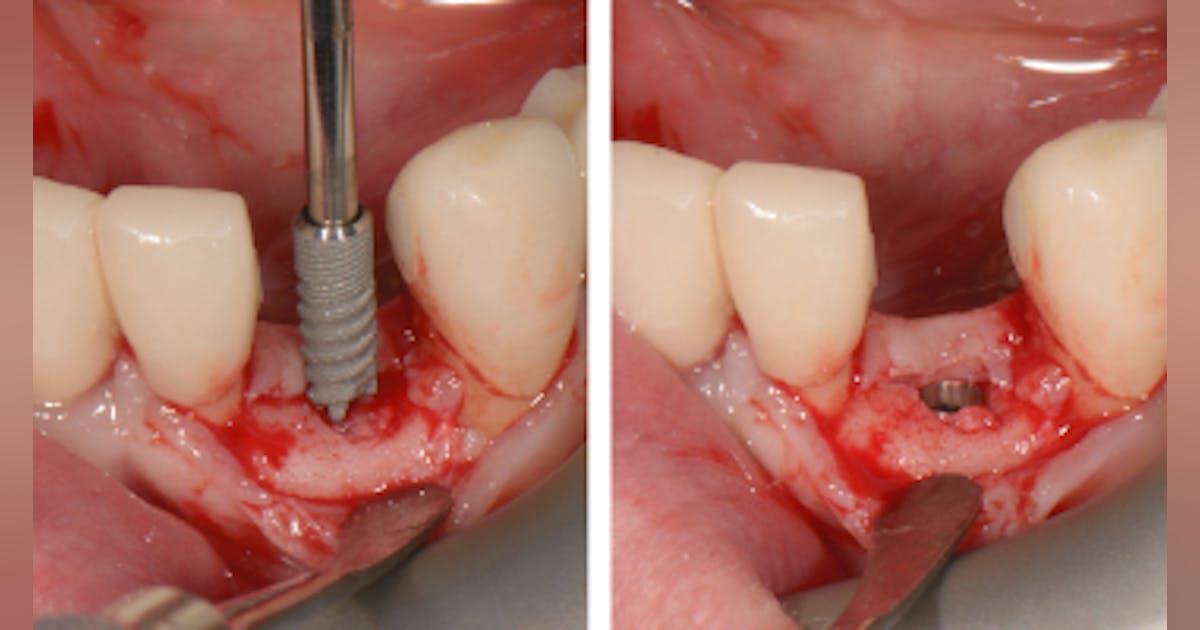 Illustrative example of sr dental implants from Google Search