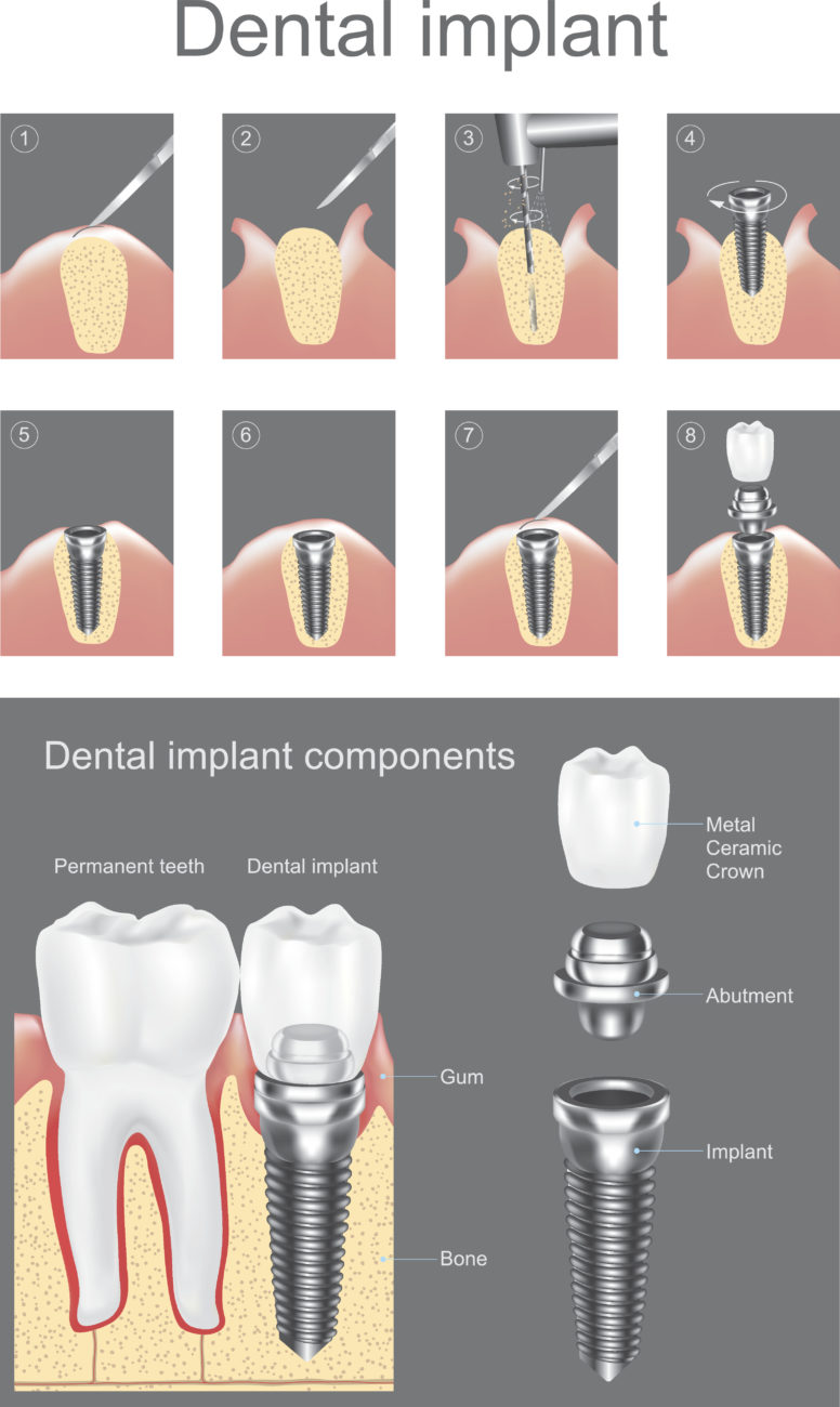 Illustrative example of stages of dental implants from Google Search