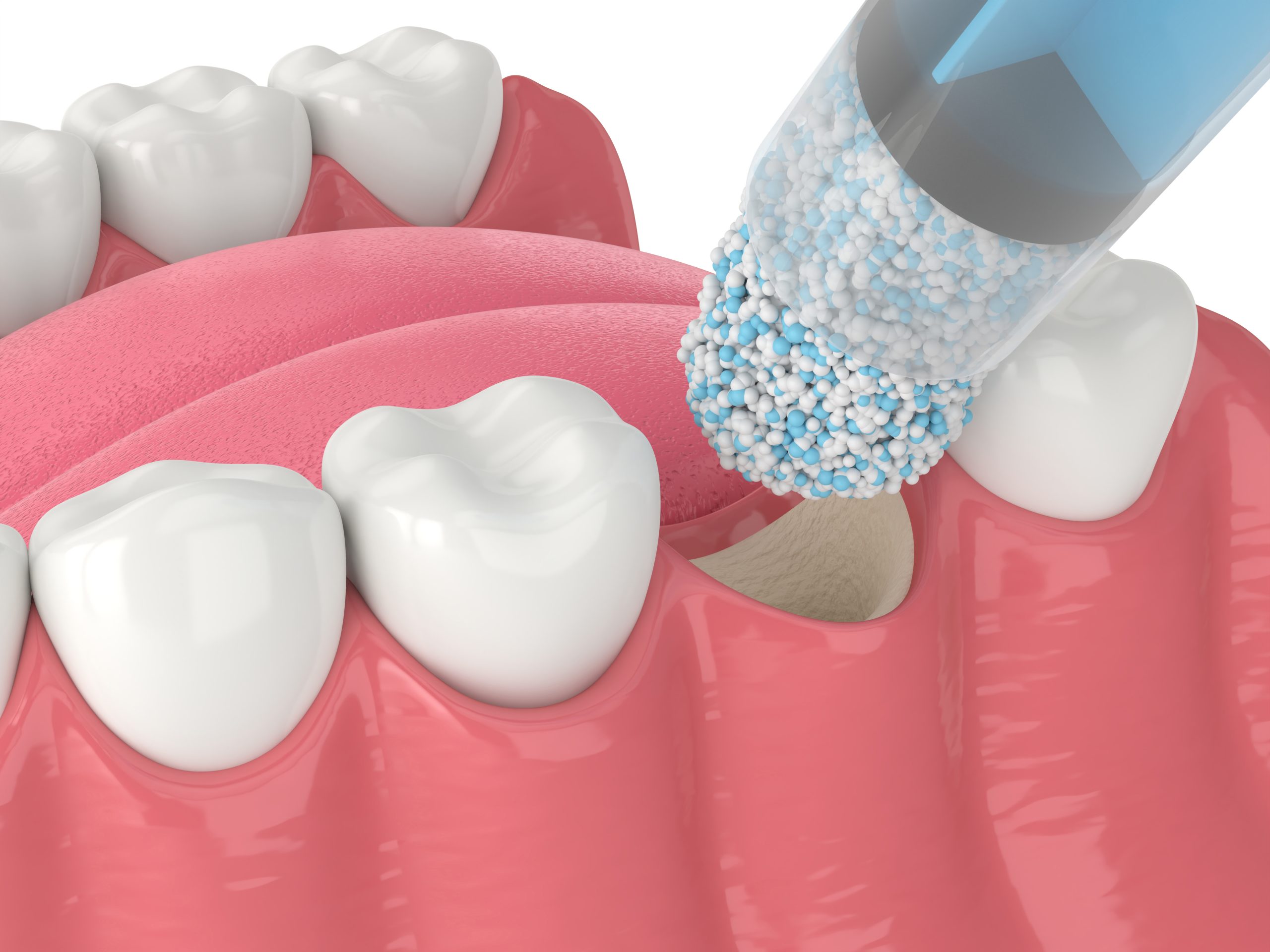 Illustrative example of stem cell dental implants from Google Search