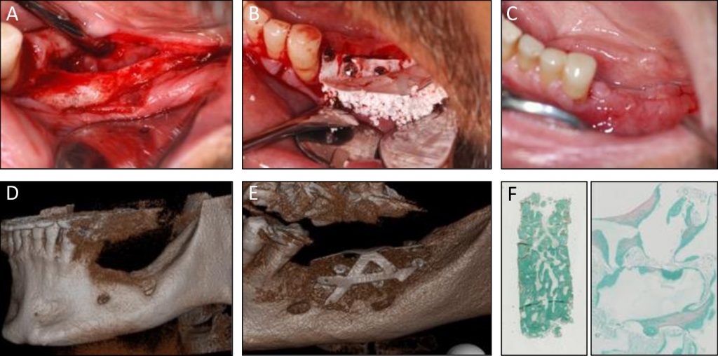 Illustrative example of stem cell dental implants from Google Search