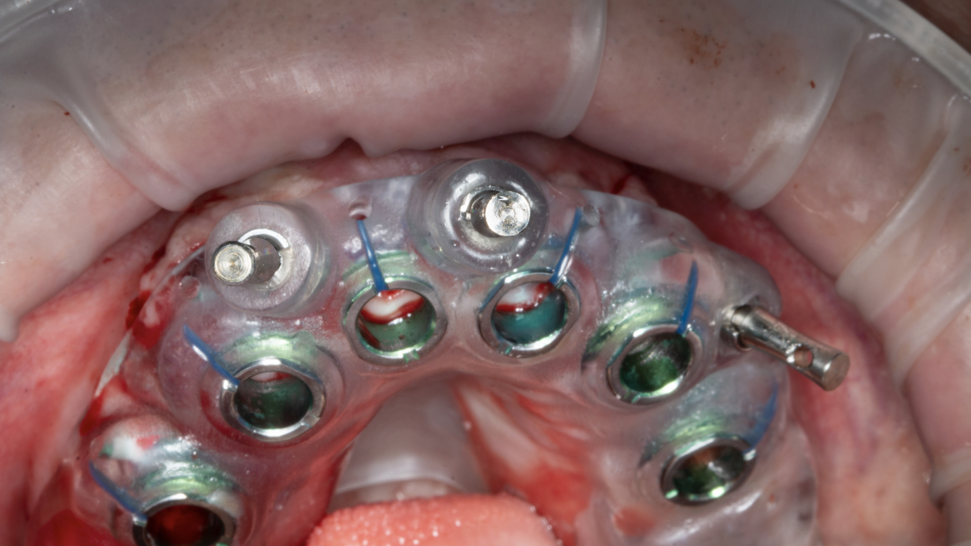 Illustrative example of surgical guide for dental implants from Google Search