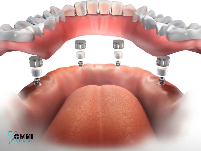 Illustrative example of thommen dental implants from Google Search