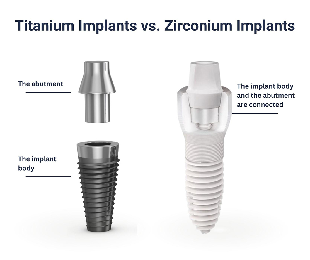 Illustrative example of titanium vs ceramic dental implants from Google Search