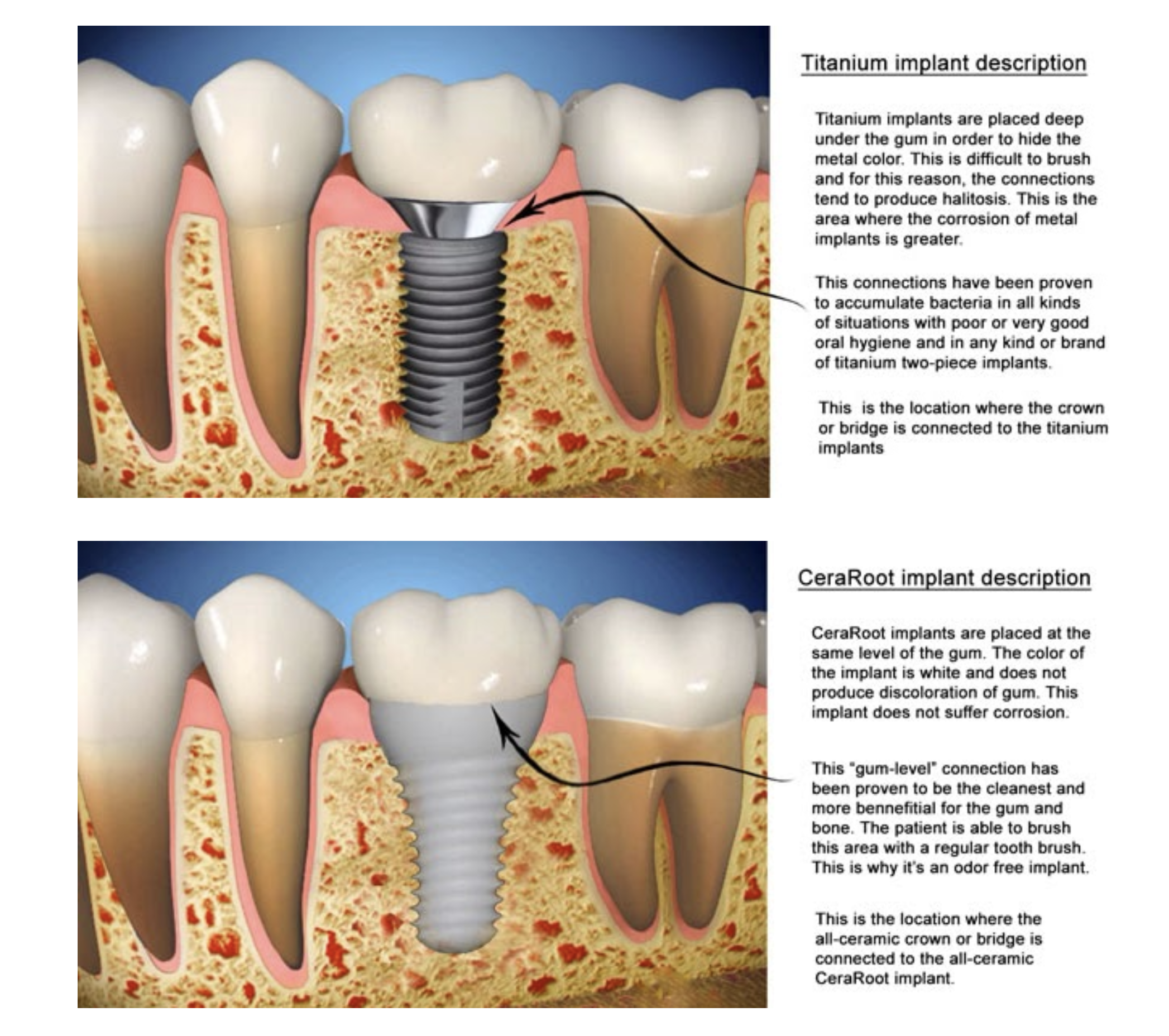 Illustrative example of titanium vs ceramic dental implants from Google Search