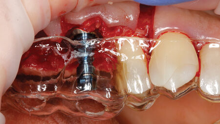 Illustrative example of tooth extraction and dental implants from Google Search