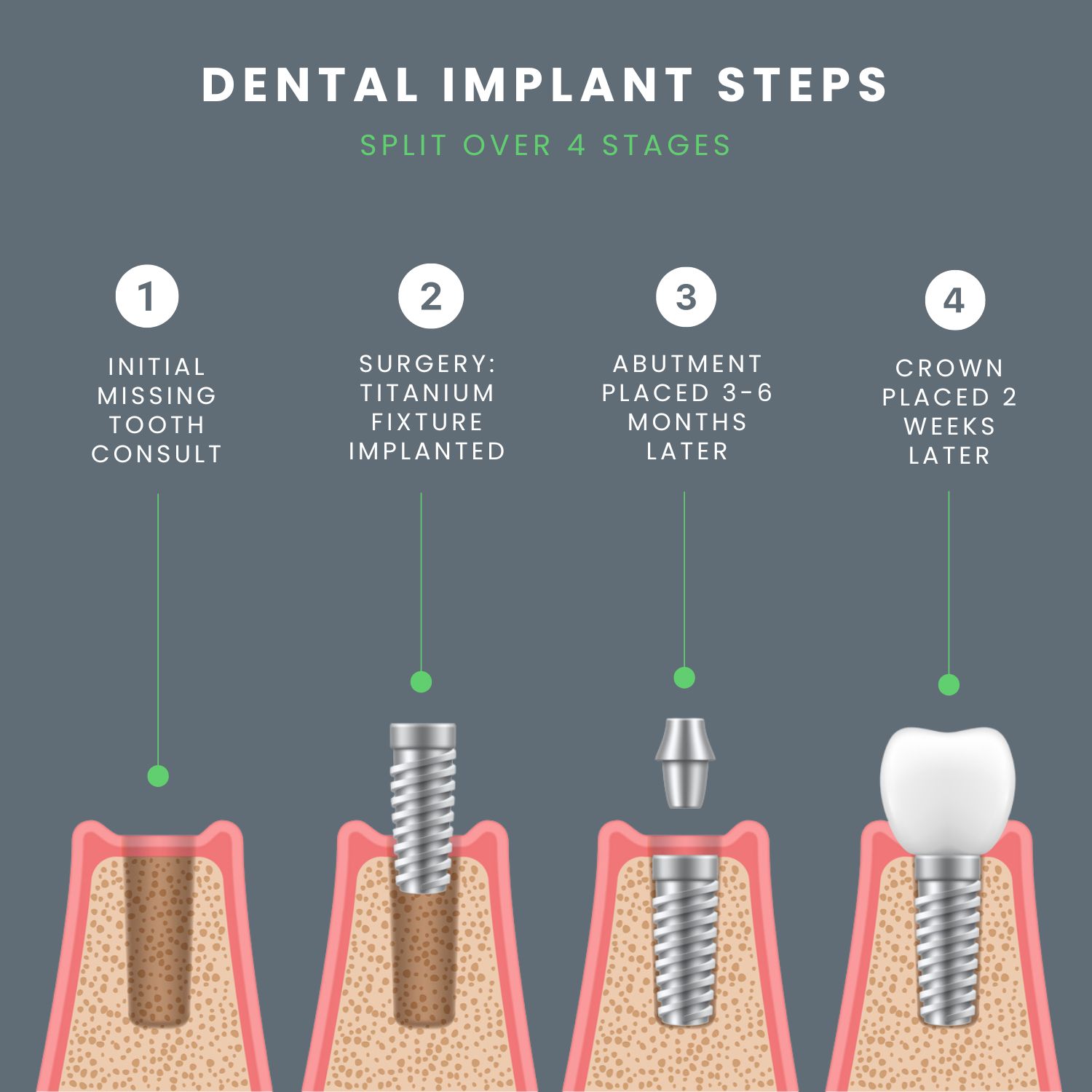 Illustrative example of tooth extraction and dental implants from Google Search