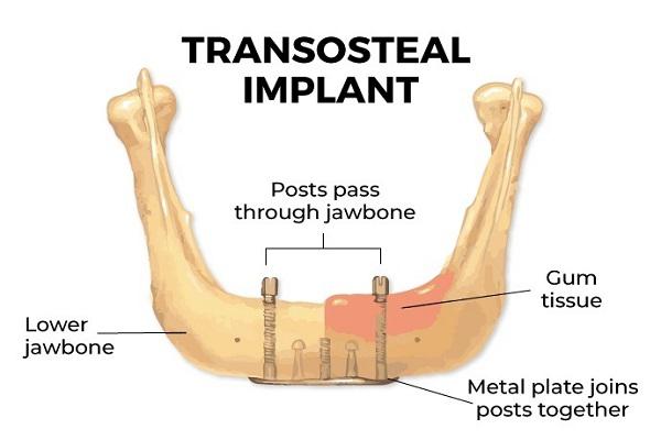 Illustrative example of transosteal dental implants from Google Search