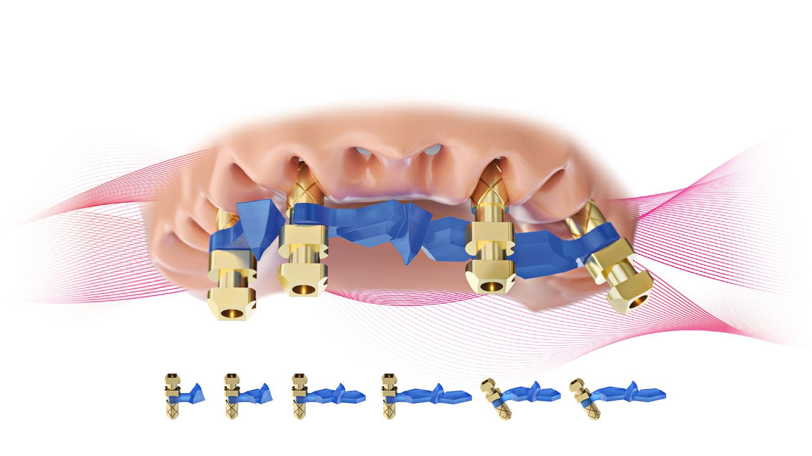 Illustrative example of tri dental implants from Google Search