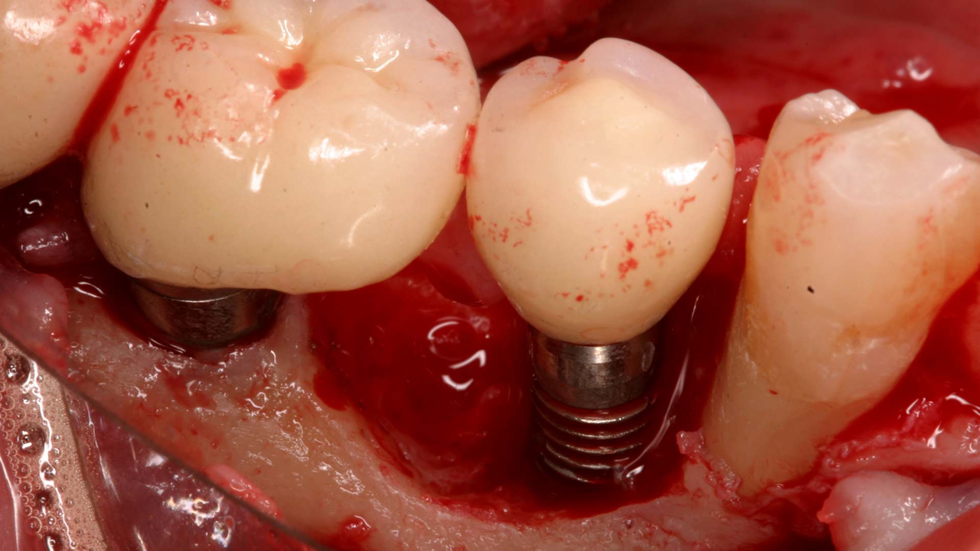 Illustrative example of truth about dental implants from Google Search
