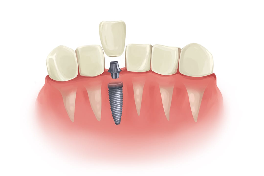 Illustrative example of truth about dental implants from Google Search