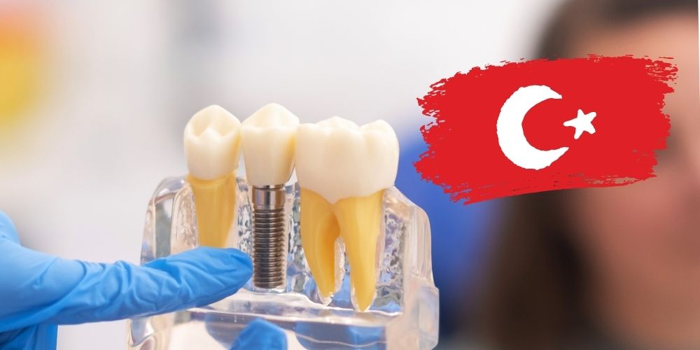 Illustrative example of turkish dental implants from Google Search