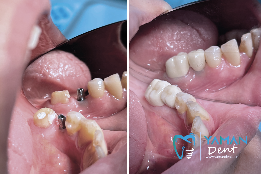 Illustrative example of turkish dental implants from Google Search