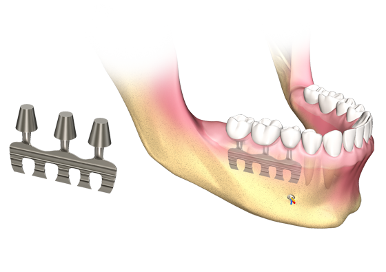 Illustrative example of type of dental implants from Google Search