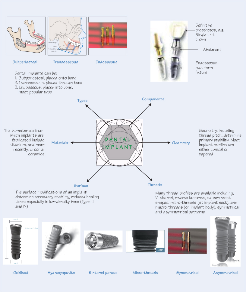 Illustrative example of types of dental implants materials from Google Search