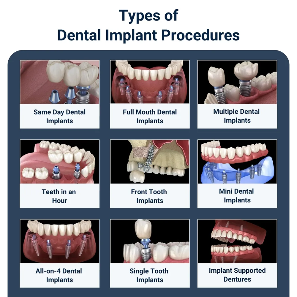 Illustrative example of types of dental implants pictures from Google Search
