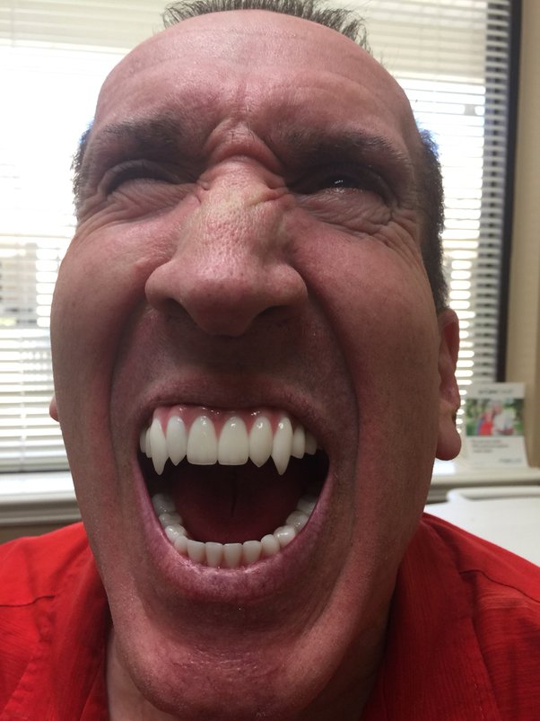 Illustrative example of vampire teeth dental implants from Google Search
