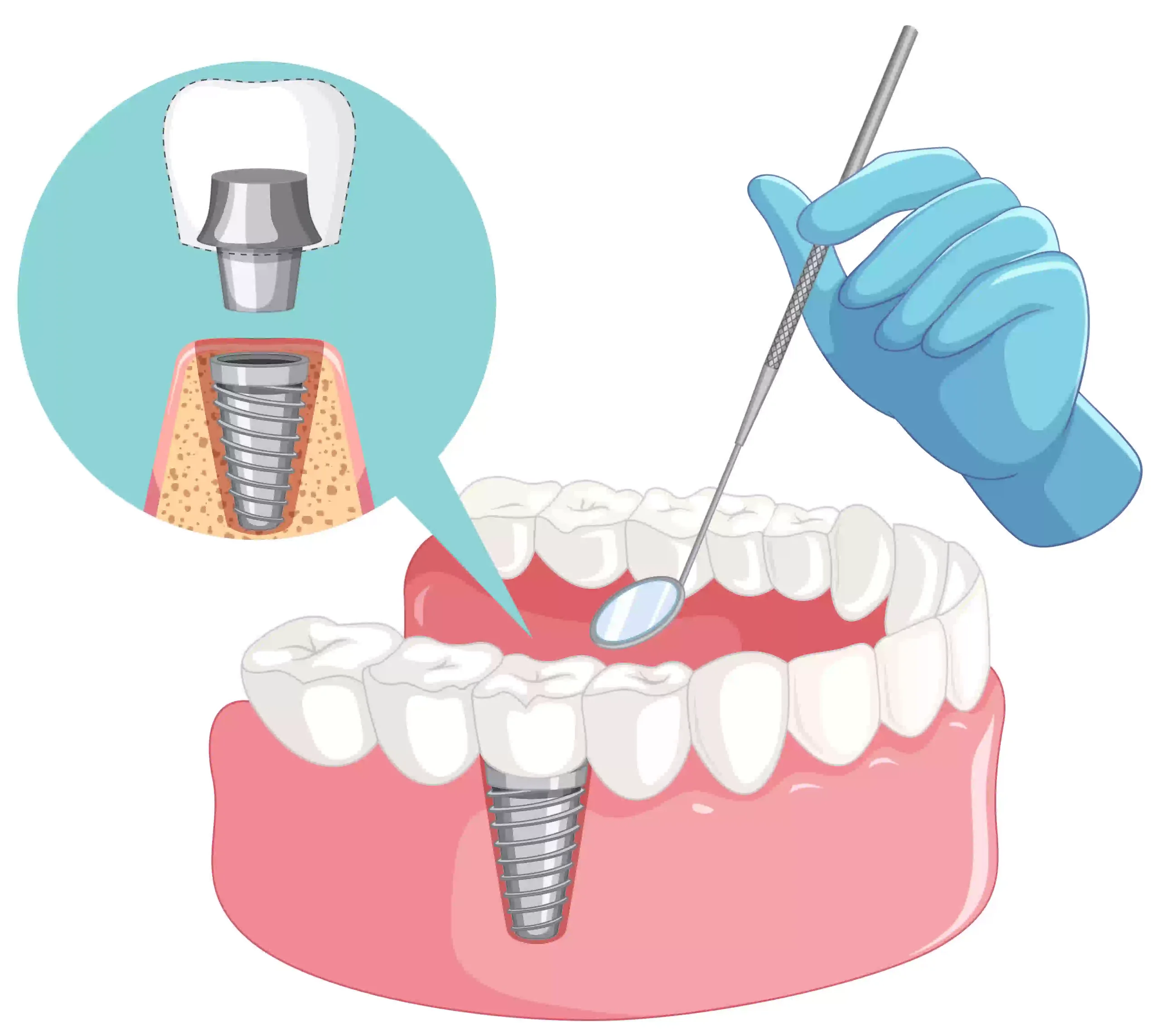 Illustrative example of zimmer biomet dental implants from Google Search
