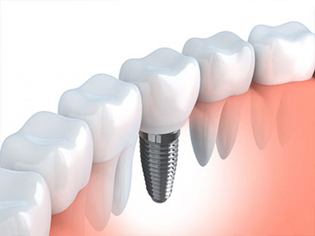Illustrative example of zircon dental implants from Google Search