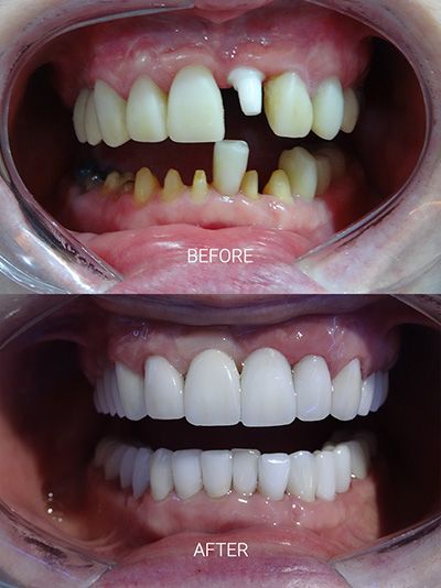 Illustrative example of zirconia dental implants from Google Search