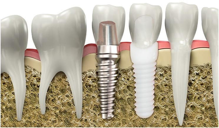Illustrative example of zirconium dental implants from Google Search