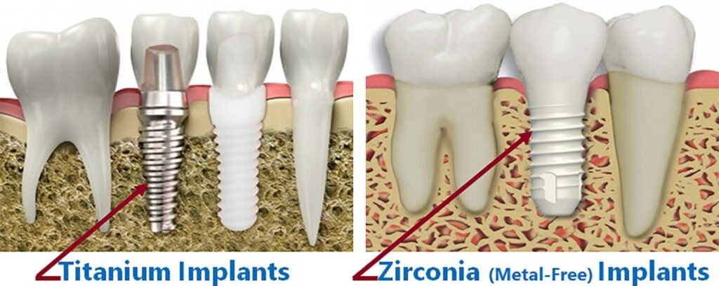 Illustrative example of zirconium dental implants side effects from Google Search