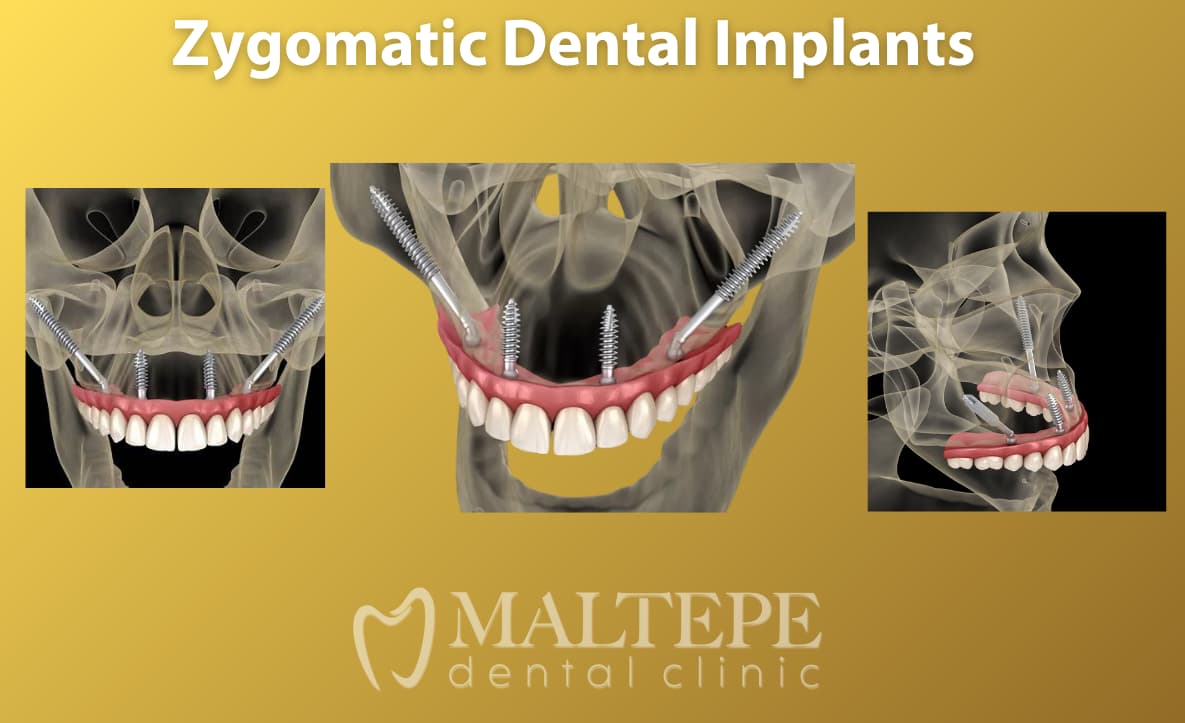 Illustrative example of zygomatic dental implants from Google Search