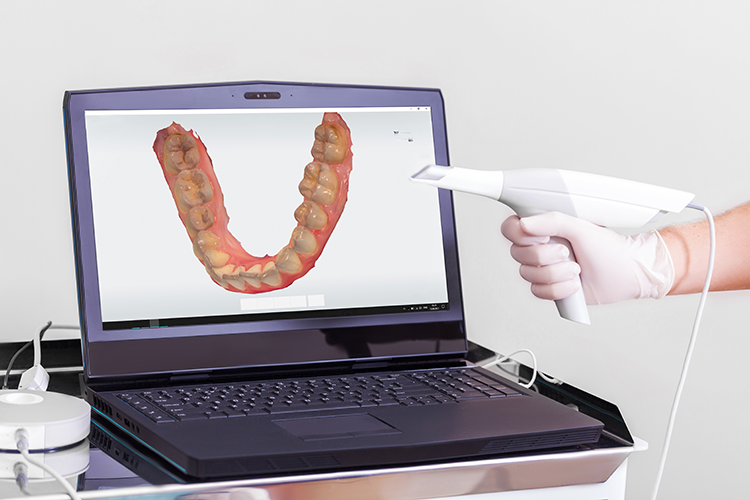 impronta dentale con scanner